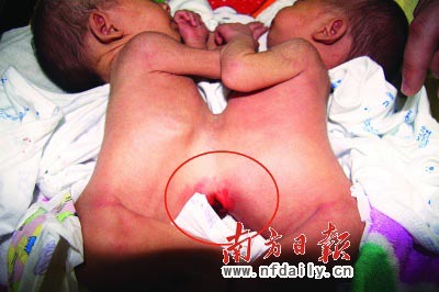 连体女婴成功实施分离手术后出院(组图)