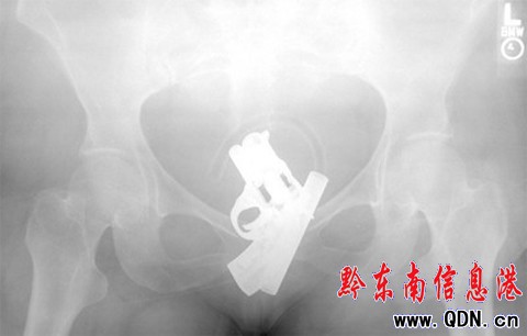 十大最惨x光照片 剪刀竟卡在喉咙里(组图)