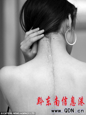 17岁女孩车祸后打破瘫痪预言当上模特